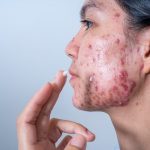 7 Cara Menghilangkan Bekas Jerawat Hitam (PIH) Secara Alami dan Cepat dalam 1 Minggu