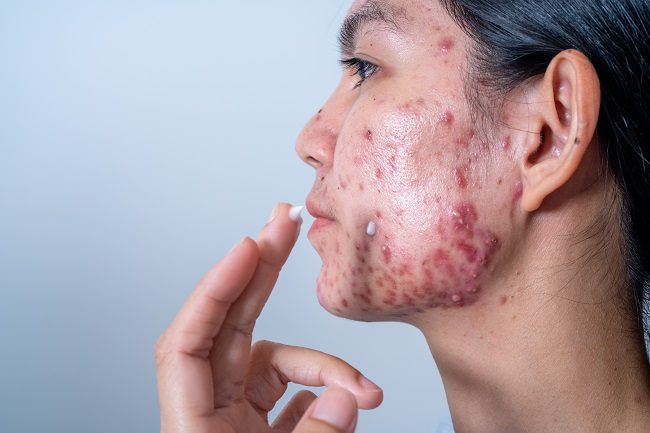 7 Cara Menghilangkan Bekas Jerawat Hitam (PIH) Secara Alami dan Cepat dalam 1 Minggu